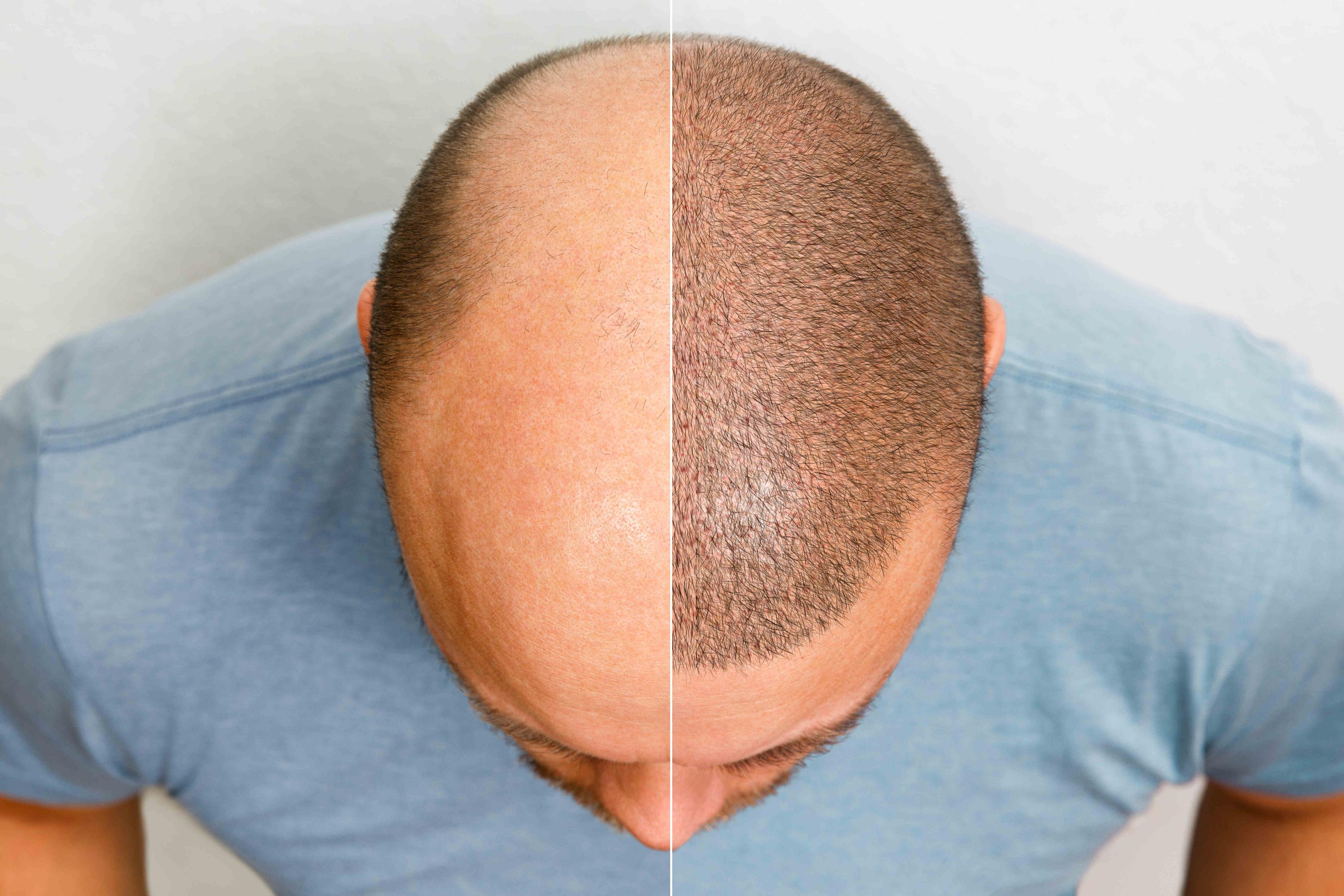 Latest in Hair Transplantation: Combat Hair Loss Image 3